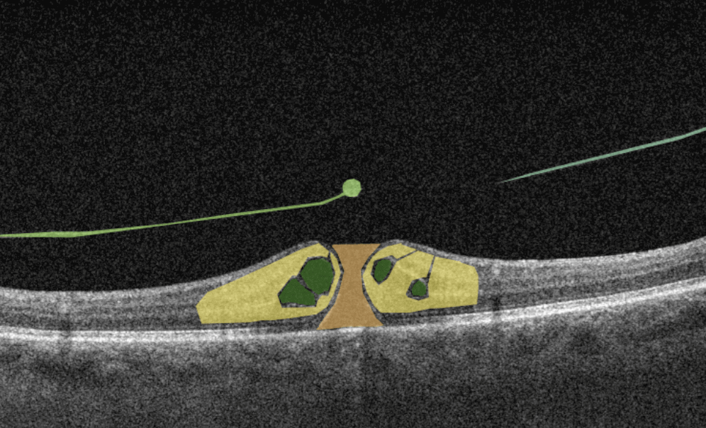 AI for Full-thickness Macular Hole