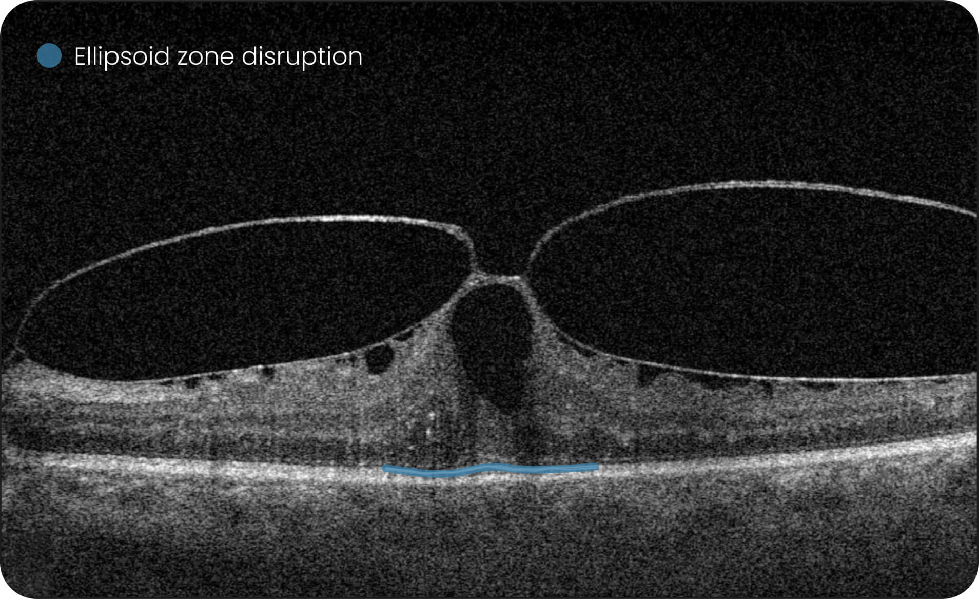 AI OCT For Ophthalmologists Altris