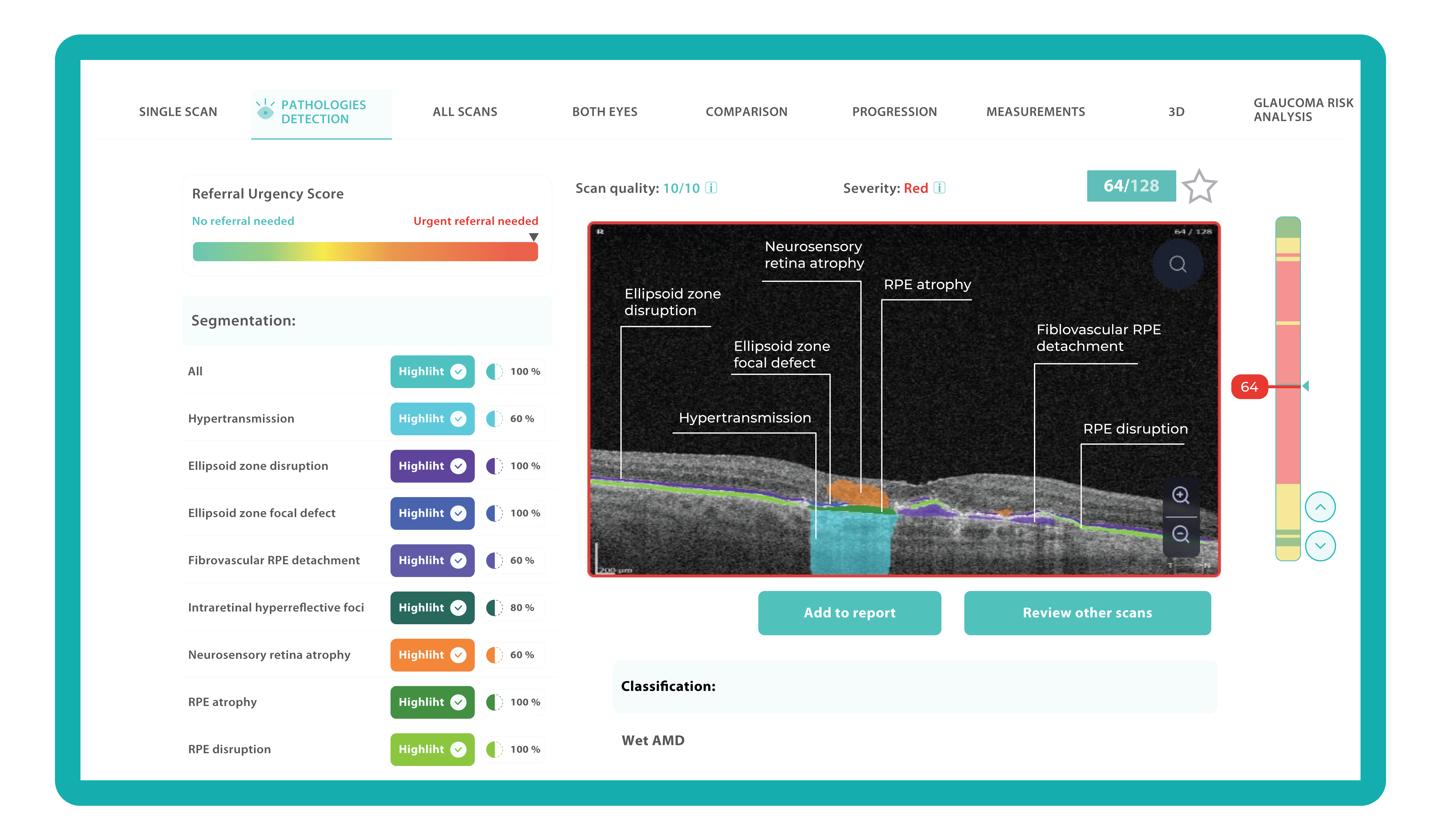 Biomarkers detected by Altris AI on OCT