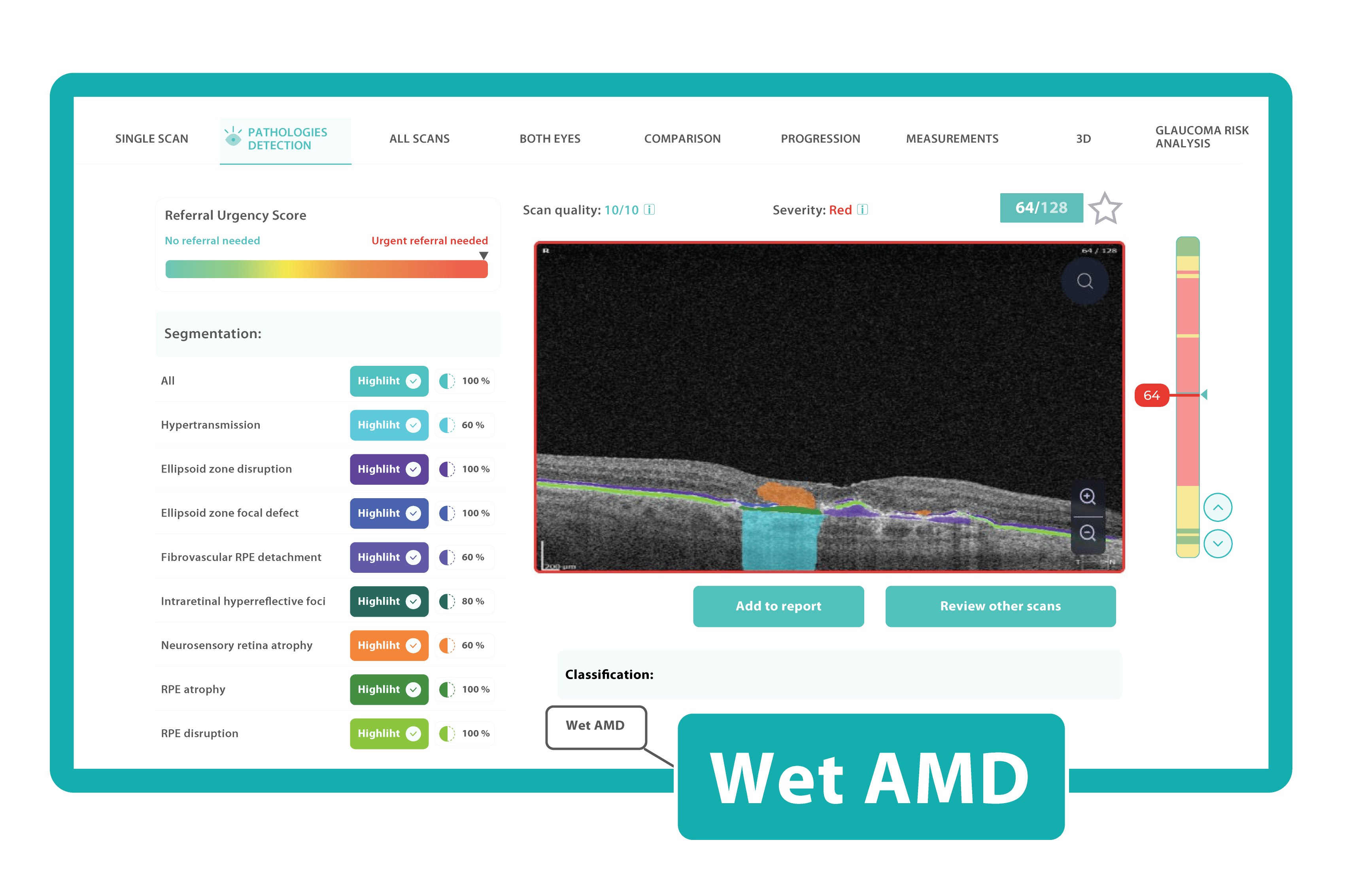 Screenshot of Wet AMD detected by Altris AI