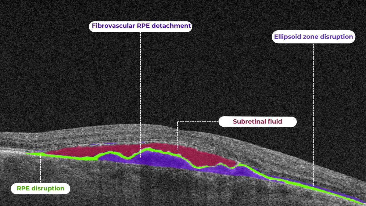 Detected by AI for OCT, Altris AI, biomarkers of Fibrovascular RPE Detachment on OCT scan: RPE disruption, Fibrovascular RPE Detachment , Subretinal fluid, Ellipsoid zone disruption
