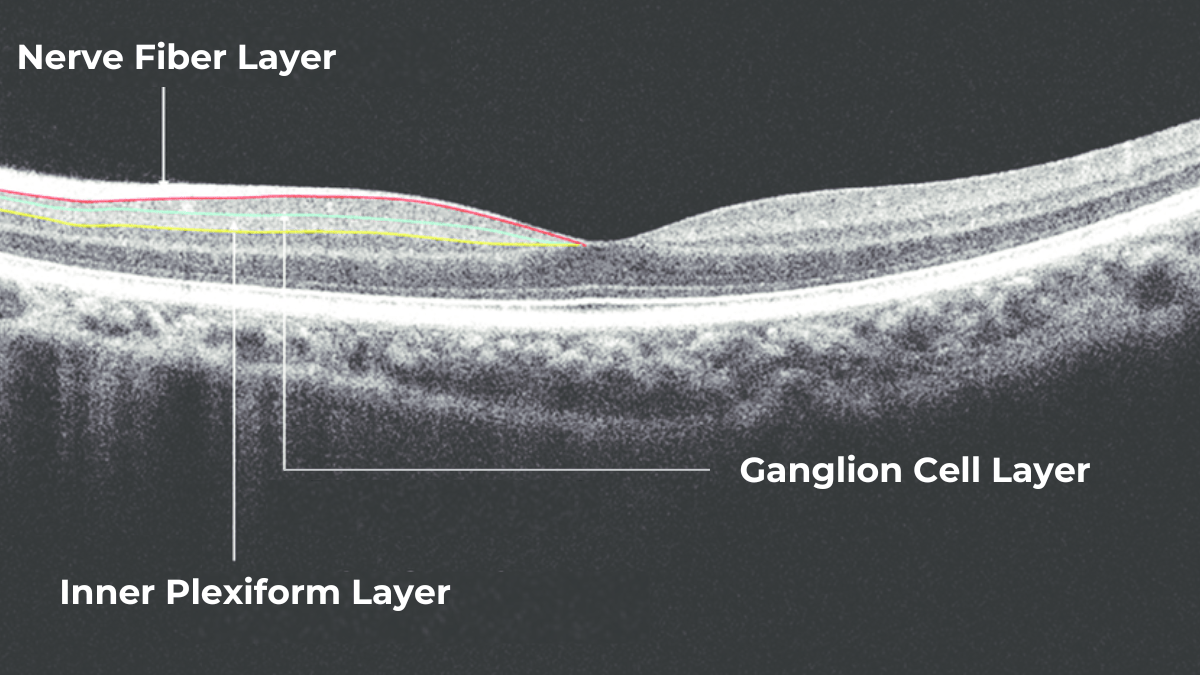 Retinal Layers shown on OCT, including Inner Plexiform Layer, Nerve Fiber Layer and Ganglion Cell Complex
