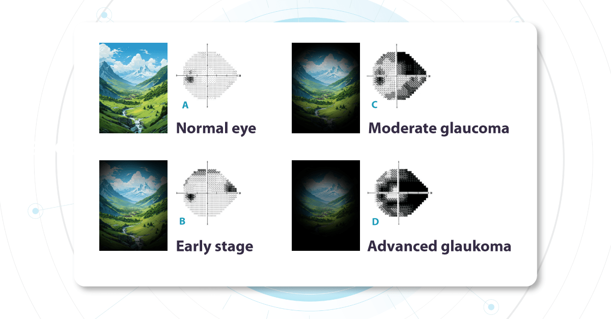 Vision text for glaucoma detection