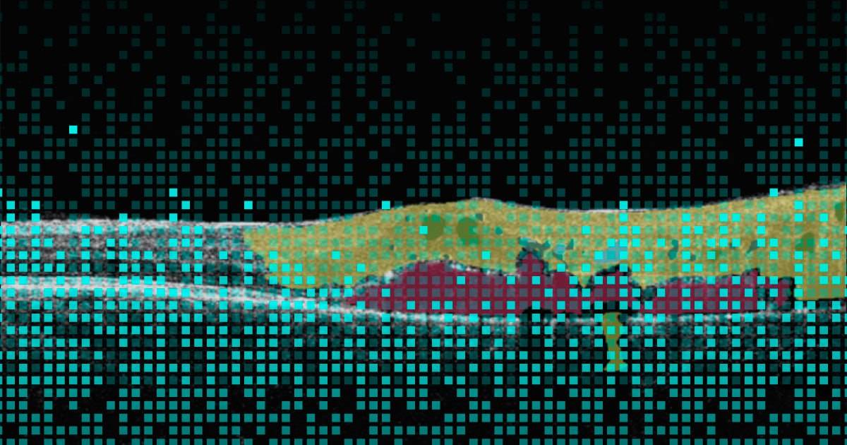 AI color coding in eye care, segmented by pixels pathologies on OCT