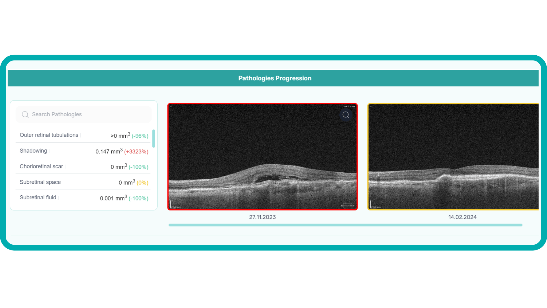 Pathology Progression, part of Altris AI OCT report