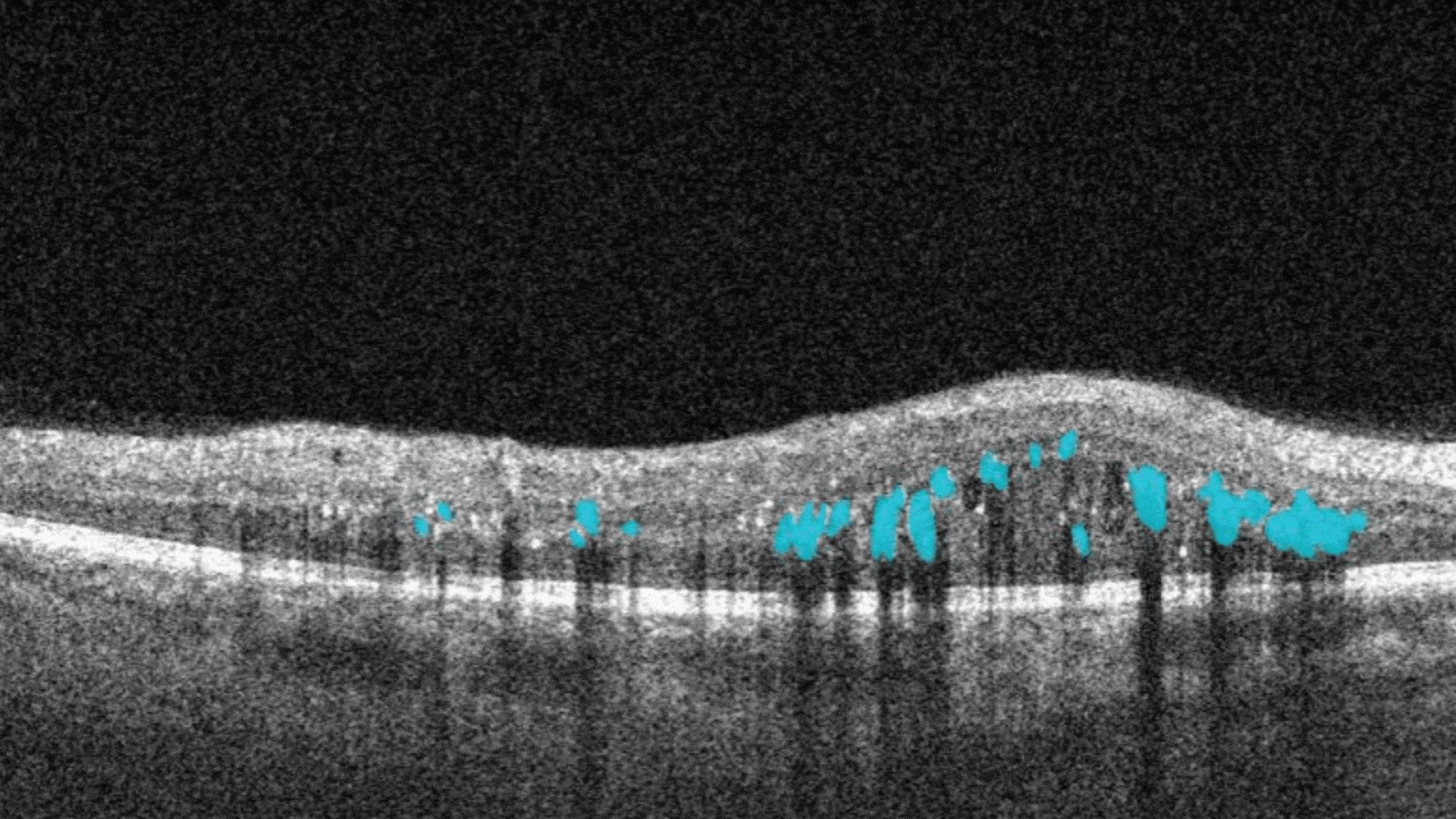 Biomarker of Diabetic Retinopathy, Hard Exudates