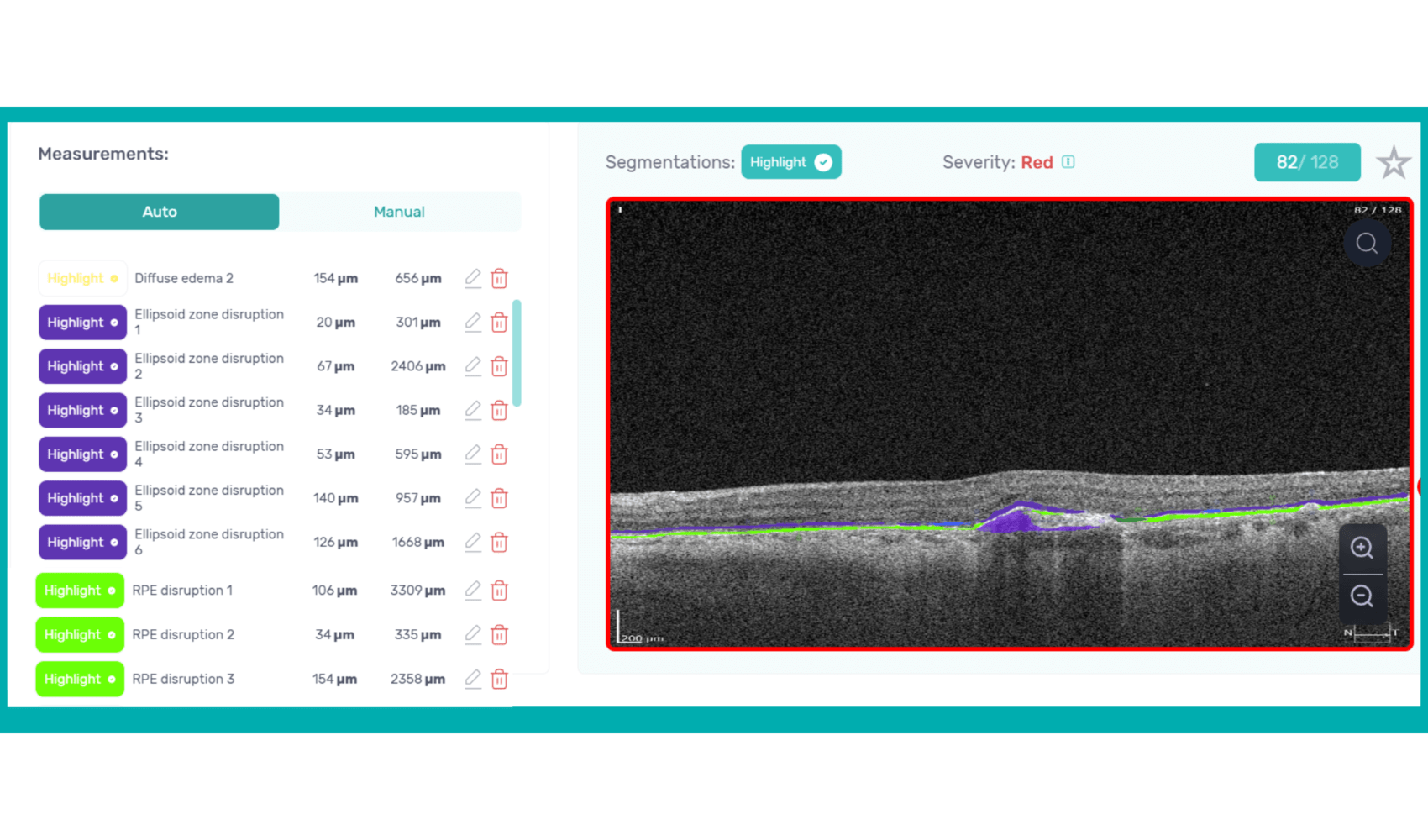 Biomarkers measuring on Altris AI OCT report