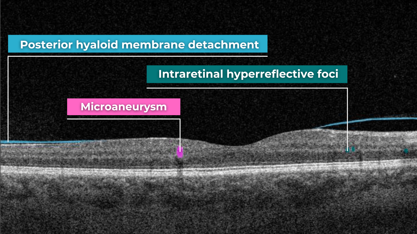 OCT Scan Normal Eye Vs 8 Most Common Pathologies OCT Scan Normal Eye Vs 8 Most Common Pathologies
