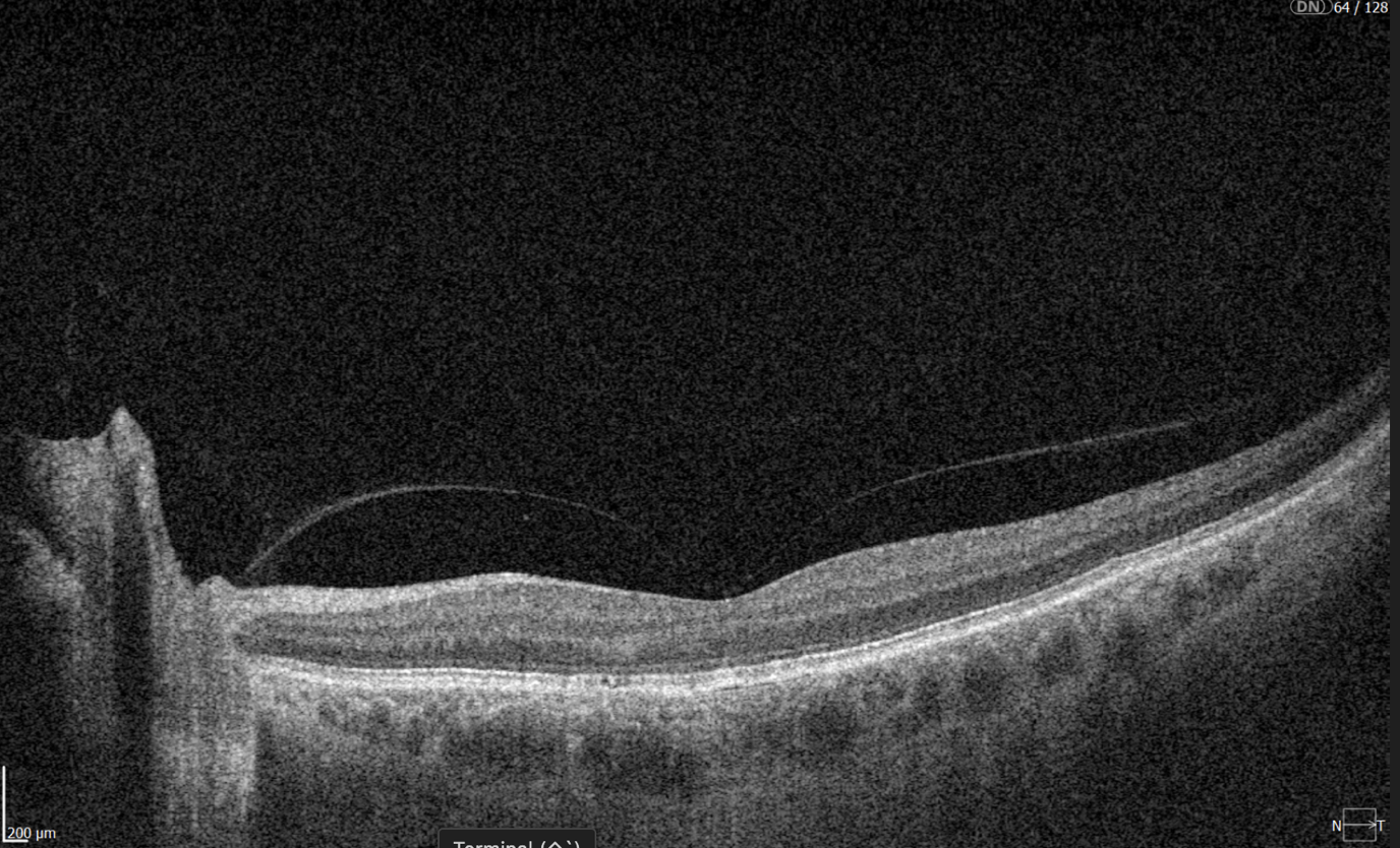 3d wide glaucoma report
