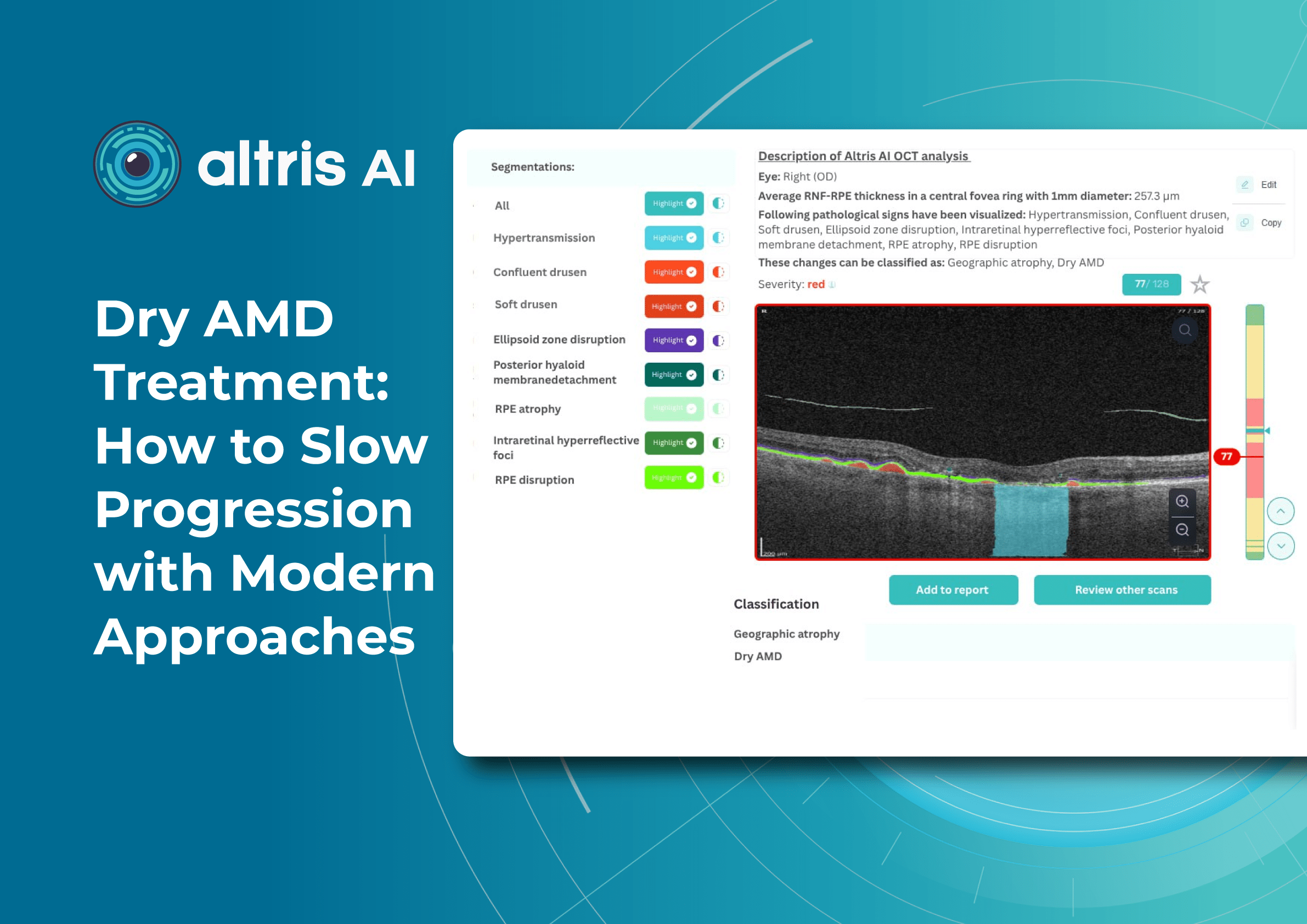 Dry AMD Treatment: Modern Approaches