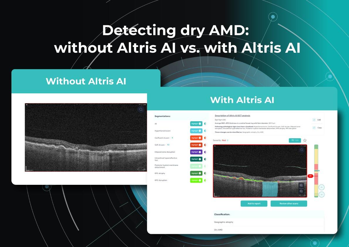 Macular degeneration monitoring without and with Altris AI