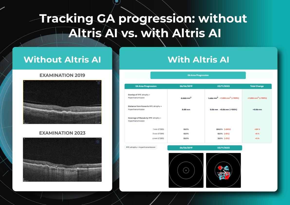 AMD progression and GA progression tracking