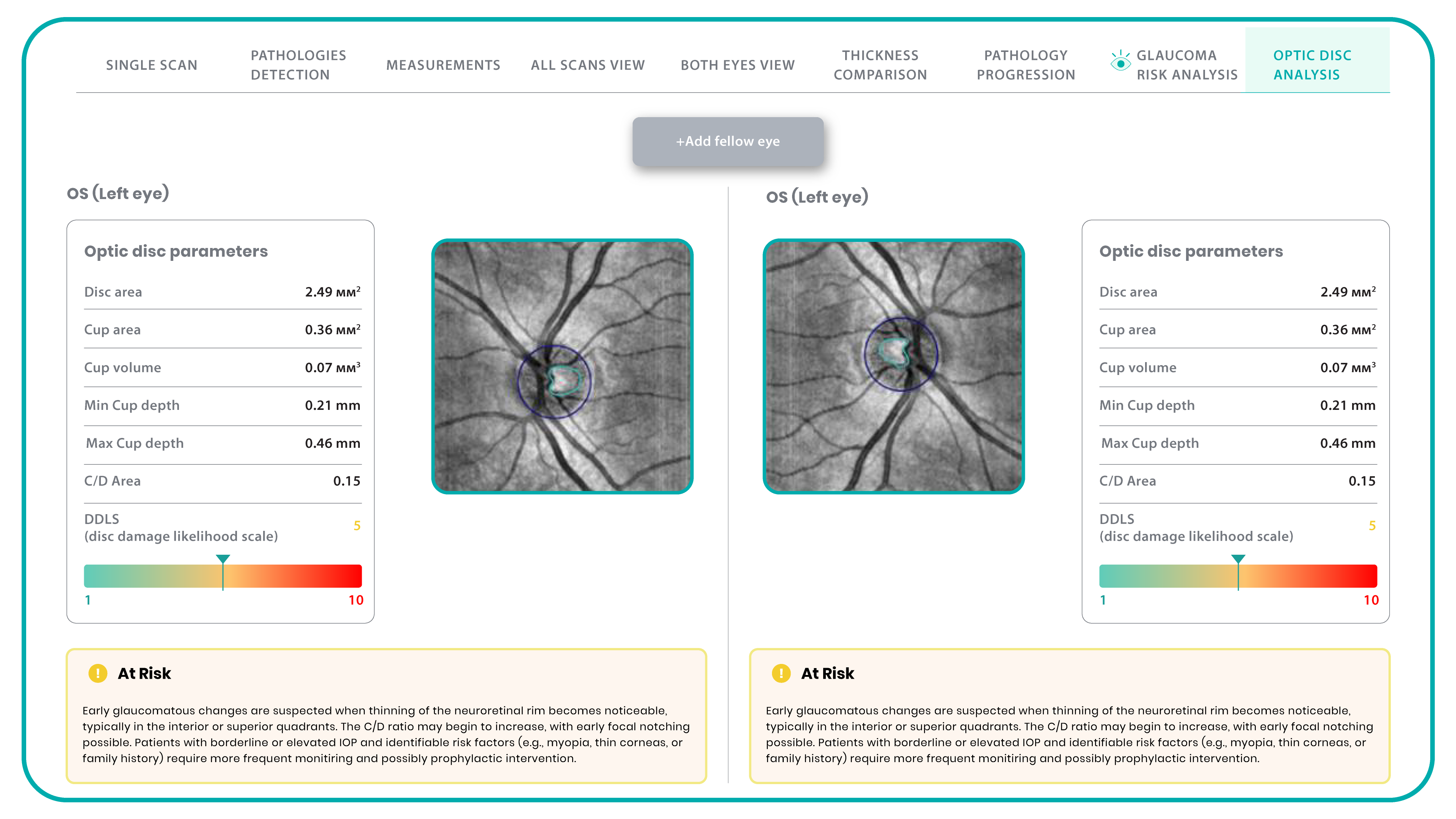 Glaucoma oct assessment