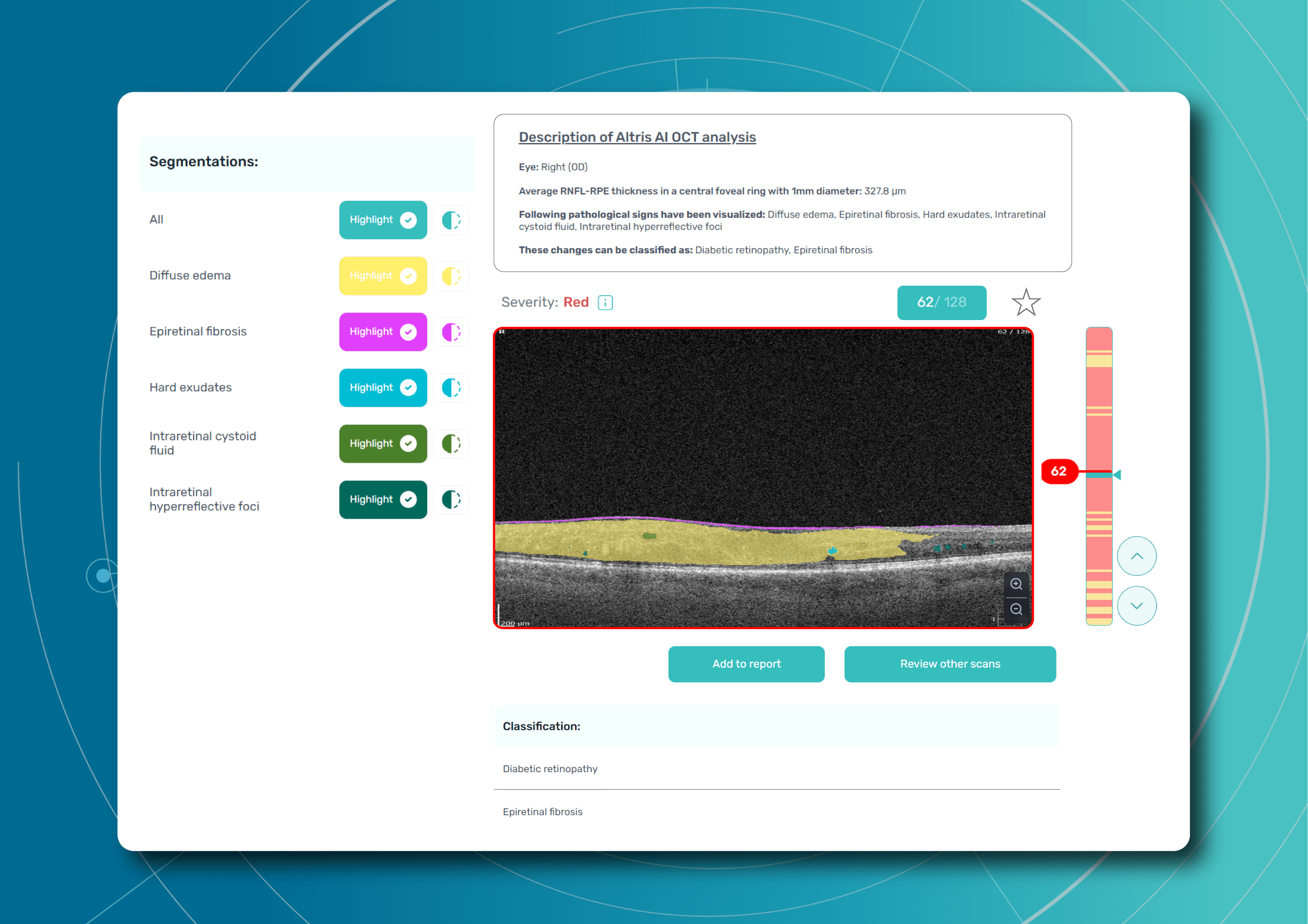 Diabetic Retinopathy Screening with AI