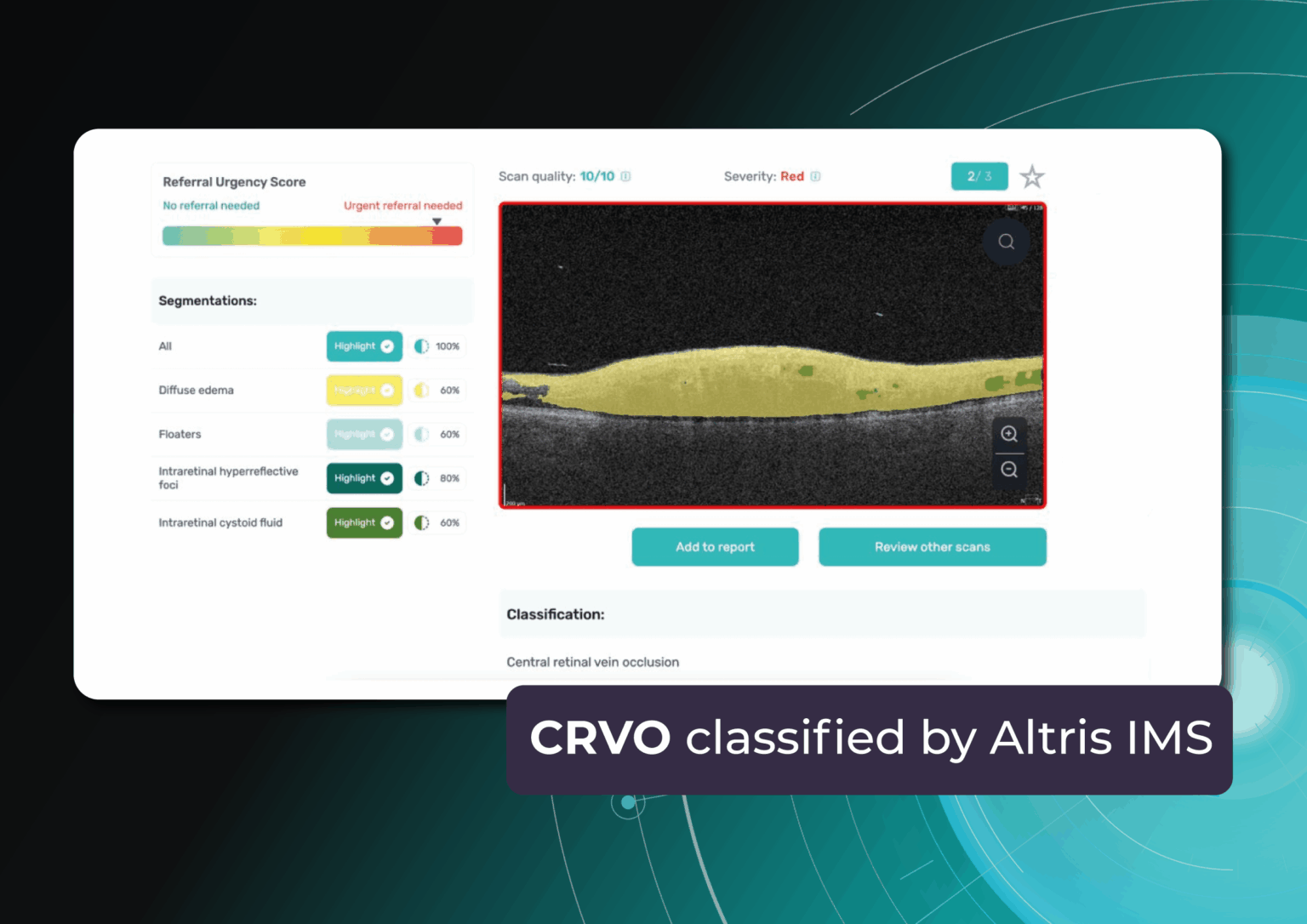 Central Retinal Vein Occlusion CRVO OCT: Detection and Modern ...