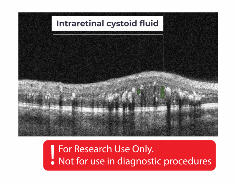 cystoid fluid