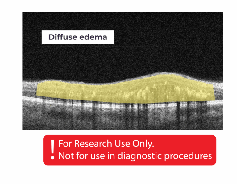 diffuse edema