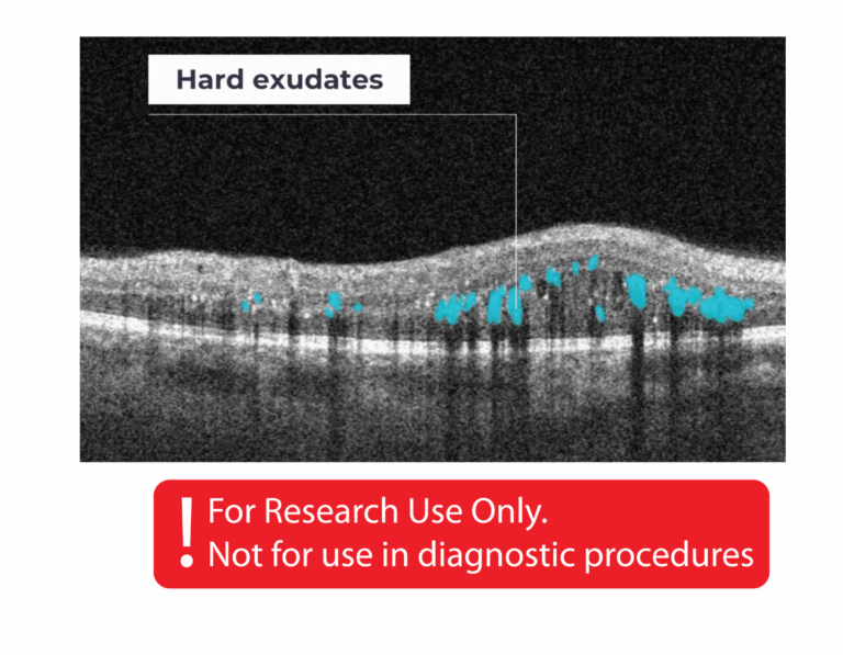 hard exudates