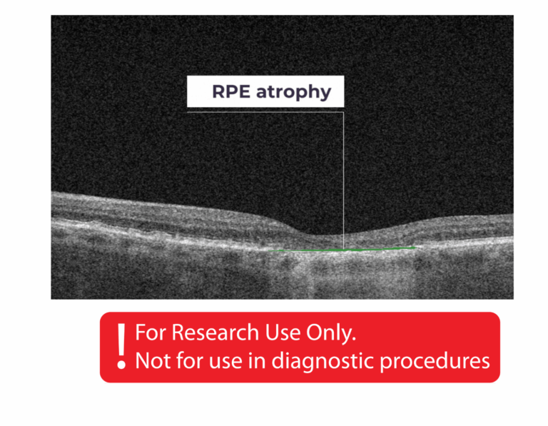 RPE atrophy